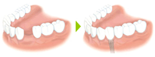 歯を一本失った場合
