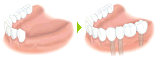 歯を数本失った場合