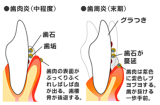 歯周病の原因