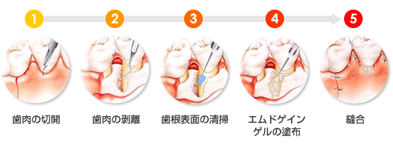 歯周病の外科手術について